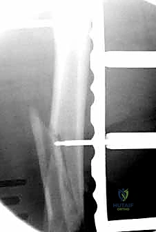 تأثير هشاشة العظام على الكسر