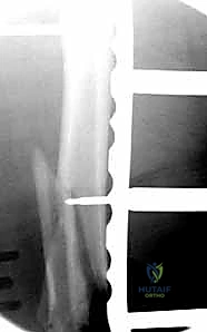 صورة طبية: كسور عظم الفخذ البعيدة: دليل شامل للعلاج والتعافي مع الأستاذ الدكتور محمد هطيف