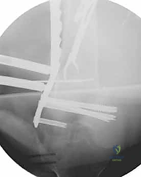 صورة شعاعية لكسر مفتت