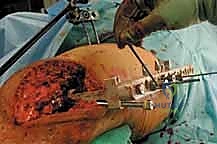 صورة طبية: كسور عظم الفخذ البعيدة: دليل شامل للعلاج والتعافي مع الأستاذ الدكتور محمد هطيف