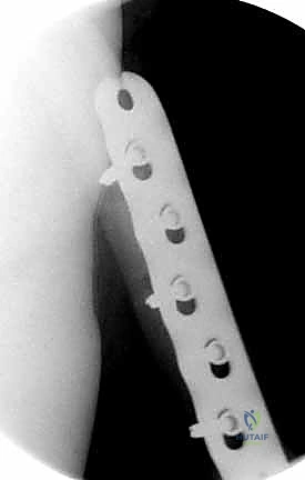 صورة طبية: كسور عظم الفخذ البعيدة: دليل شامل للعلاج والتعافي مع الأستاذ الدكتور محمد هطيف