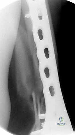 صورة طبية: كسور عظم الفخذ البعيدة: دليل شامل للعلاج والتعافي مع الأستاذ الدكتور محمد هطيف