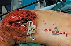 إرجاع القطع العظمية