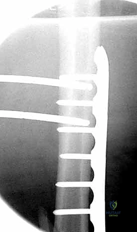 التثبيت المزدوج لزيادة القوة