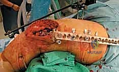 صورة طبية: كسور عظم الفخذ البعيدة: دليل شامل للعلاج والتعافي مع الأستاذ الدكتور محمد هطيف