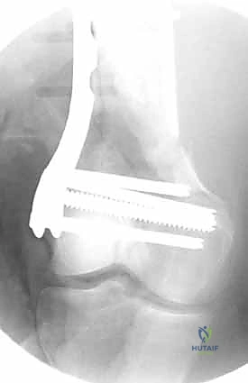 كسر ناتج عن حادث سير