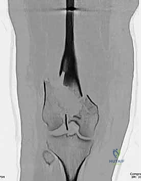 أدوات التثبيت الحديثة