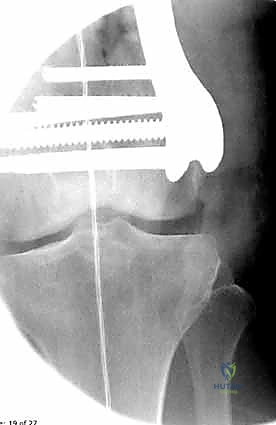 إدخال الشريحة التشريحية