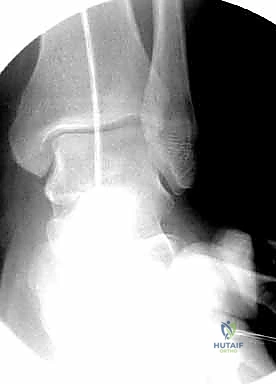 قياس طول المسمار المناسب