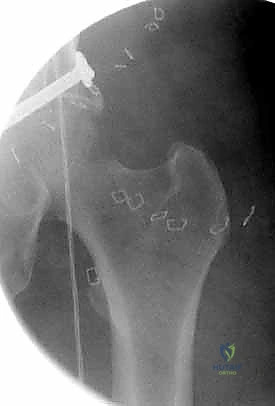 تجهيز شريحة ثانية للكسور المعقدة