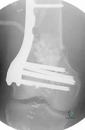 غسيل الجرح وتنظيفه