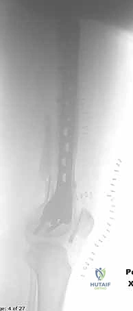 إدخال المسمار الأول