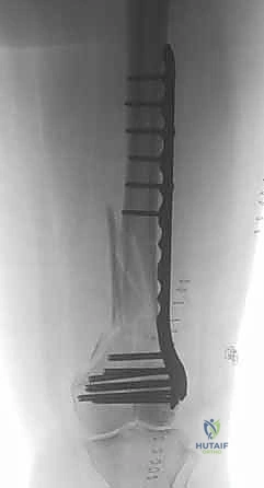 صورة طبية: كسور عظم الفخذ البعيدة: دليل شامل للعلاج والتعافي مع الأستاذ الدكتور محمد هطيف