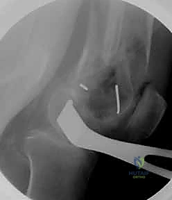 ضبط الشريحة على العظم