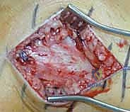 صورة طبية: كسور عظم الفخذ البعيدة: دليل شامل للعلاج والتعافي مع الأستاذ الدكتور محمد هطيف