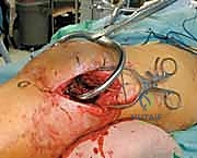 صورة طبية: كسور عظم الفخذ البعيدة: دليل شامل للعلاج والتعافي مع الأستاذ الدكتور محمد هطيف