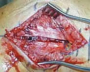 تغطية الجرح بالضمادات المعقمة