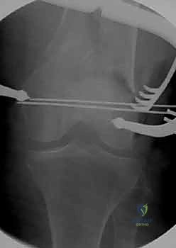صورة توضيحية لـ كسور عظم الفخذ البعيدة: دليل شامل للعلاج والتعافي مع الأستاذ الدكتور محمد هطيف