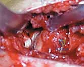 صورة طبية: كسور عظم الفخذ البعيدة: دليل شامل للعلاج والتعافي مع الأستاذ الدكتور محمد هطيف