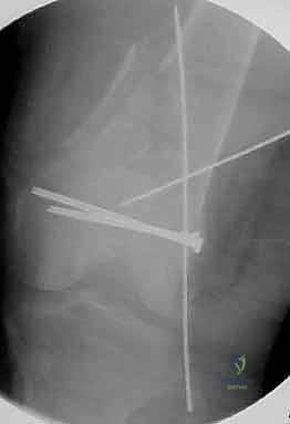 التدقيق في تفاصيل الكسر