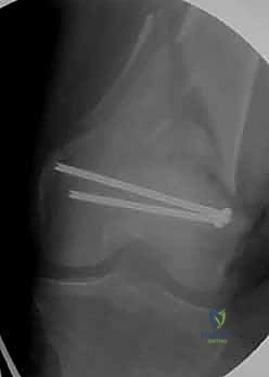 تثبيت الجزء السفلي من الشريحة