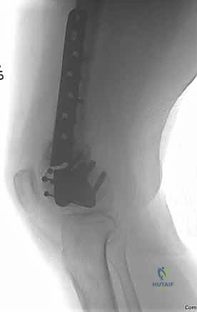 Mastering Distal Femur ORIF: An Intraoperative Guide to Complex Fractures