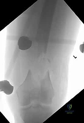 استخدام الملاقط الجراحية لتثبيت العظم المبدئي