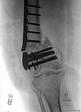 صورة توضيحية لـ كسور عظم الفخذ البعيدة: دليل شامل للعلاج والتعافي مع الأستاذ الدكتور محمد هطيف