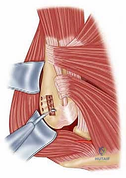 فصل وتر العضلة الصدرية الكبرى بدقة متناهية