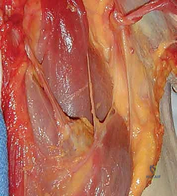 تجهيز الوتر المنقول بخيوط جراحية فائقة القوة