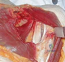 التحضير النهائي للوتر قبل عملية التثبيت في العظم