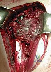 تثبيت الوتر في مكانه الجديد باستخدام خطاطيف جراحية