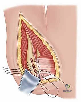 نظرة مقربة على نقطة التثبيت العظمية للوتر المنقول
