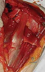 الخطوات النهائية لضمان استقرار الوتر في موقعه التشريحي الجديد