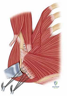 نقل العضلة الصدرية الكبرى: حل مبتكر لإصلاح تمزقات تحت الكتف غير القابلة للإصلاح