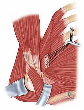 صورة شعاعية / توضيحية لنتيجة التثبيت النهائية بعد العملية
