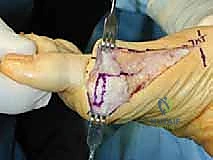 صورة توضيحية لـ عملية قطع عظم شيفرون الداني بالصفيحة المغلقة: حل جذري لإبهام القدم الأروح