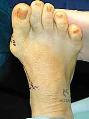 عملية قطع عظم شيفرون الداني بالصفيحة المغلقة: حل جذري لإبهام القدم الأروح