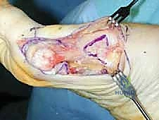 صورة توضيحية لـ عملية قطع عظم شيفرون الداني بالصفيحة المغلقة: حل جذري لإبهام القدم الأروح