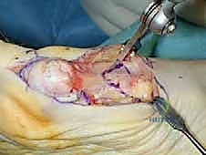 صورة توضيحية للتشريح العظمي لإبهام القدم الأروح