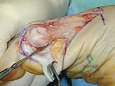 صورة توضيحية لـ عملية قطع عظم شيفرون الداني بالصفيحة المغلقة: حل جذري لإبهام القدم الأروح