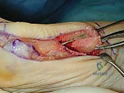 صورة توضح الخيارات العلاجية لإبهام القدم الأروح