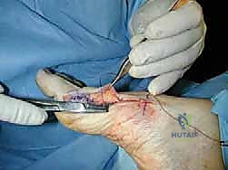 صورة طبية: عملية قطع عظم شيفرون الداني بالصفيحة المغلقة: حل جذري لإبهام القدم الأروح