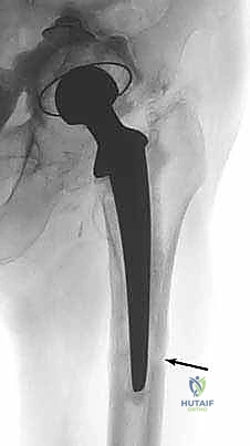 Illustration of time of reimplantation - Dr. Mohammed Hutaif