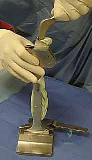 صورة توضيحية لـ ماستر كلاس: جراحة استبدال مفصل الورك على مرحلتين لعلاج التهاب المفصل المزمن بعد الجراحة باستخدام فاصل محمل بالمضادات الحيوية