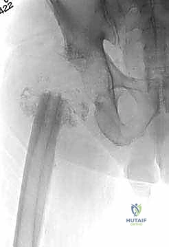 صورة توضيحية لـ ماستر كلاس: جراحة استبدال مفصل الورك على مرحلتين لعلاج التهاب المفصل المزمن بعد الجراحة باستخدام فاصل محمل بالمضادات الحيوية