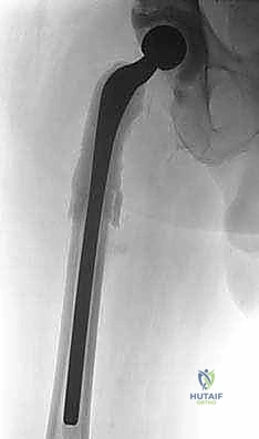 ماستر كلاس: جراحة استبدال مفصل الورك على مرحلتين لعلاج التهاب المفصل المزمن بعد الجراحة باستخدام فاصل محمل بالمضادات الحيوية