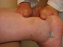 Chronic Achilles Tendon Reconstruction: V-Y Advancement with FHL Transfer Masterclass