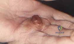 Surgical Excision of Hand Vascular Tumors: An Intraoperative Masterclass