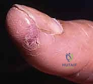 أنواع الأورام الوعائية في اليد